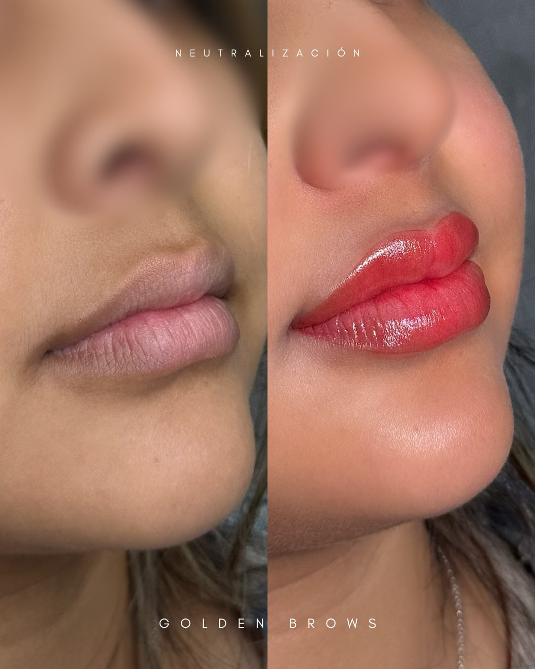 Neutralización de Labio