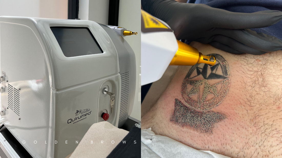 borrado de tatuajes tenerife