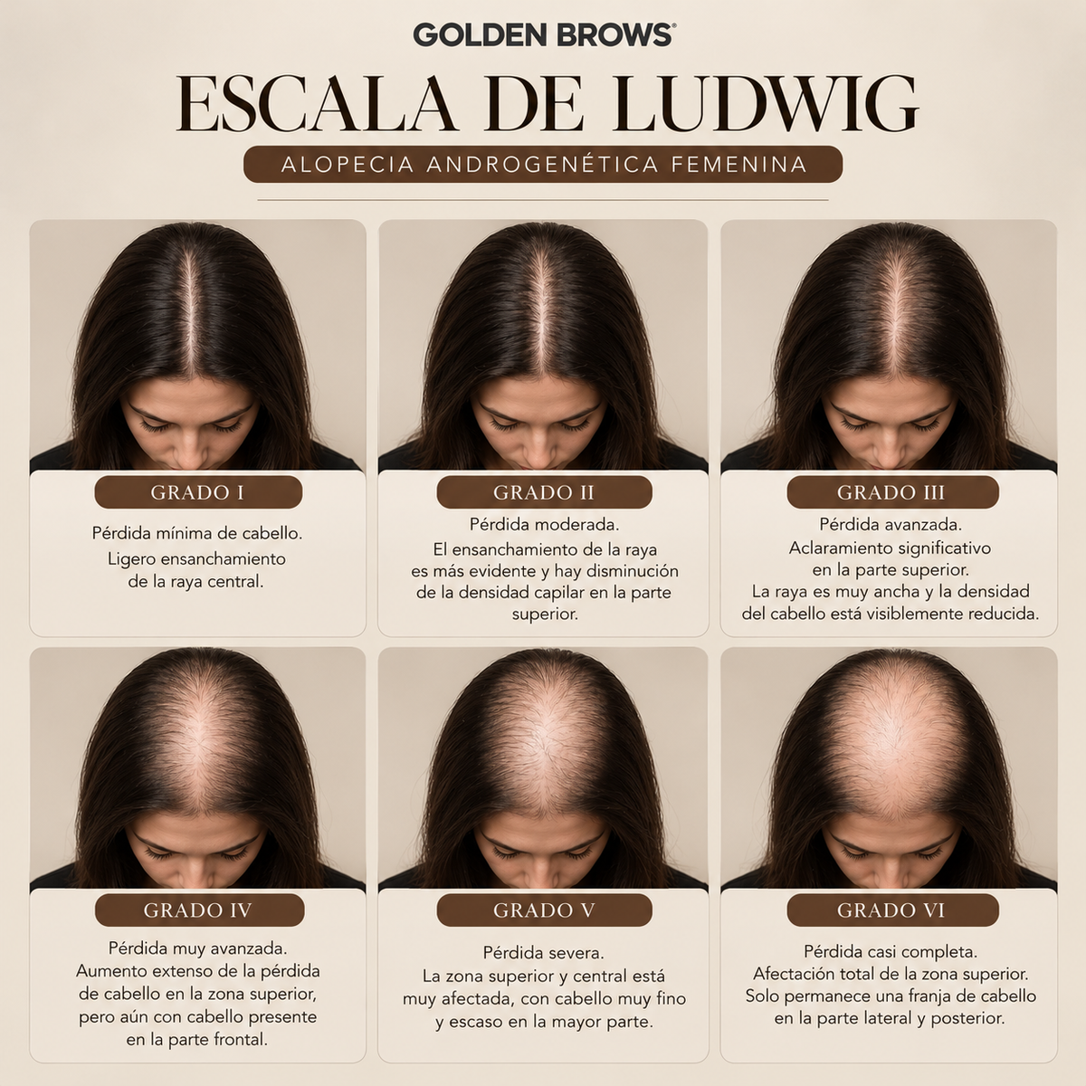 Micropigmentación Capilar SCALP en Tenerife