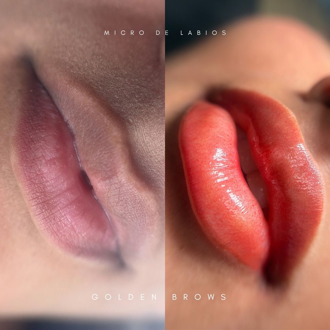 Neutralización de Labio