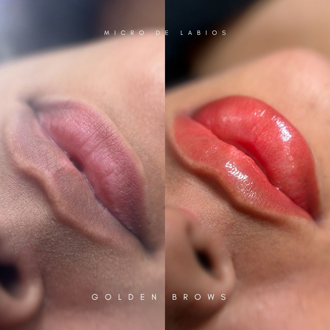 Neutralización de Labio